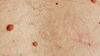 Cherry Angiomas: Say Goodbye with Thermoclear's Non-Invasive Solution - Services available in Hudson, NH near Nashua & MA