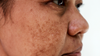 Melasma what is it? what causes it? 