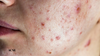 Understanding Different Types of Acne: A Comprehensive Guide - Anikabeauty