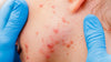 Identifying acne - anika skincare article two - acne, blackheads, milia, cysts, rosacea acne