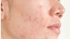 acne skincare clinic -  anika skincare and makeup - acne facials, led light therapy, holistic programs