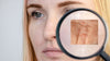 Sebaceous Hyperplasia - Non invasive treatment at Anika Skincare. Facial products to help and prevent sebaceous hyperplasia available at anikabeauty.com
