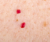 Cherry Angiomas: What are they? How Do I Get Rid of Them   anika skincare non invasive skin care treatment nashua area