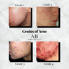 acne, understanding grades of acne, acne skincare routines, acne homecare products, acne skincare treatments at anika skincare clinic, New Hampshire and Massachusetts