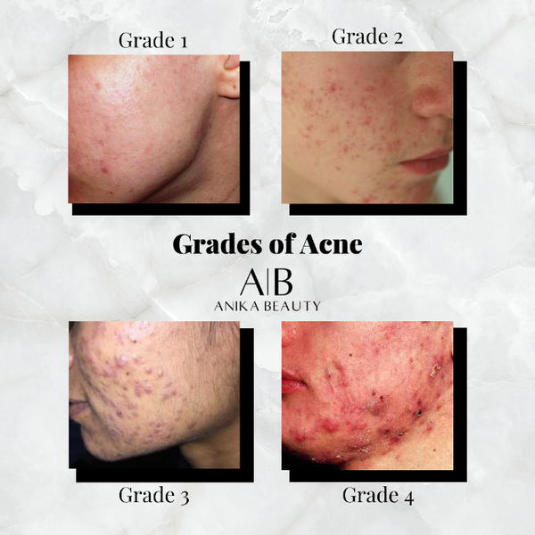 What is the #1 cause of acne?