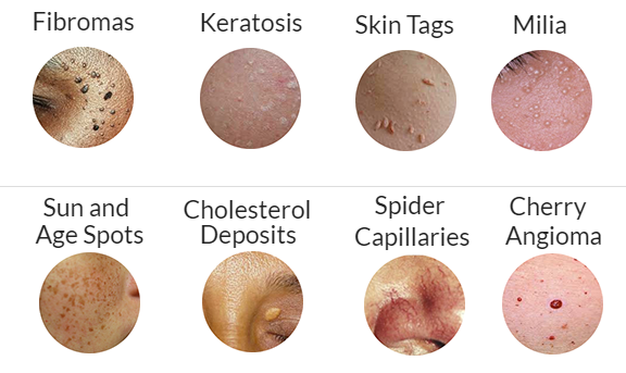radiofrequency_skin Imperfections_ face_ body_non invasive_Milia_Skin tags_Fibromas_Keratosis_Sunspots_age spots_spider capillaries_cherry anigomas